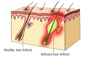 4 Ways to Prevent Ingrown Hairs